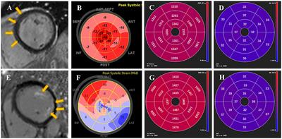 Predictive Value of Echocardiographic Strain for Myocardial Fibrosis and Adverse Outcomes in Autoimmune Diseases